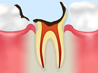 C3神経の虫歯
