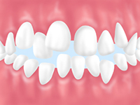歯のすきまが虫歯や歯周病の原因に